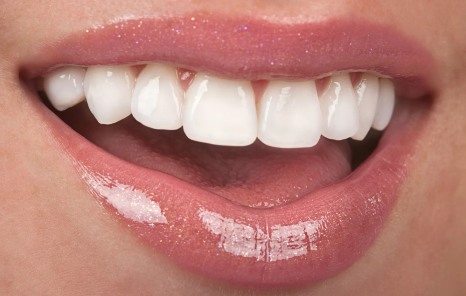 Veneer teeth in Sydney