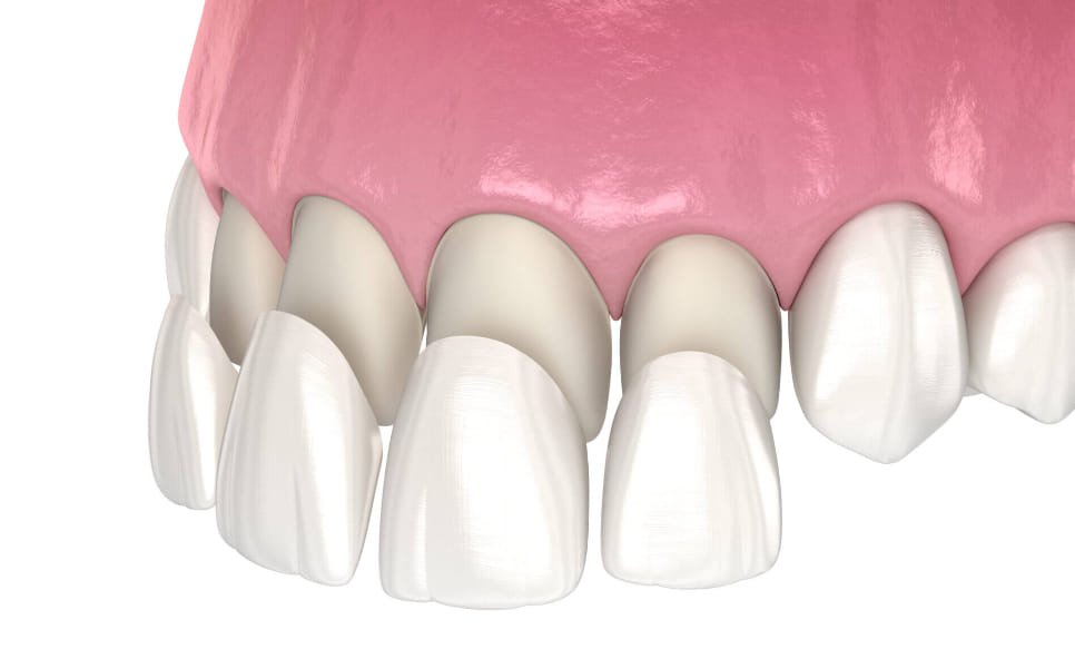 Porcelain veneers in Sydney